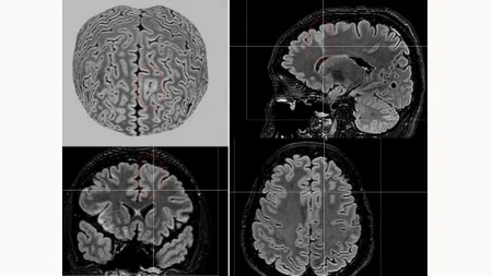 IA detecta lesões cerebrais invisíveis em pessoas com epilepsia