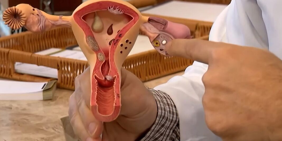 Endometriose: conheça os sintomas e saiba como tratar a doença Endometriose: conheça os sintomas e saiba como tratar a doença