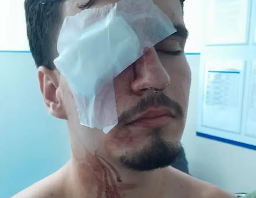 Estudante fica cego após ser atingido bala borracha Maracanã Estudante fica cego após ser atingido bala borracha Maracanã