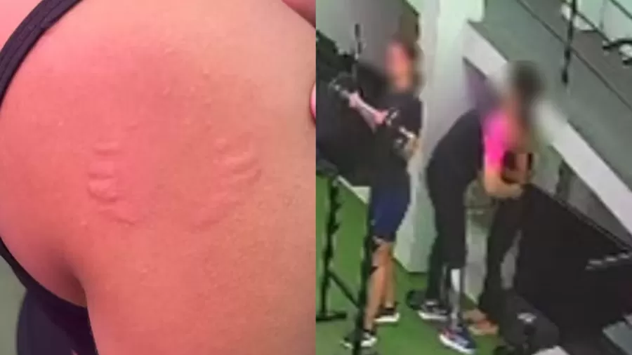 Mulher denuncia assédio após ser mordida por instrutor em academia no Recife Mulher denuncia assédio após ser mordida por instrutor em academia no Recife